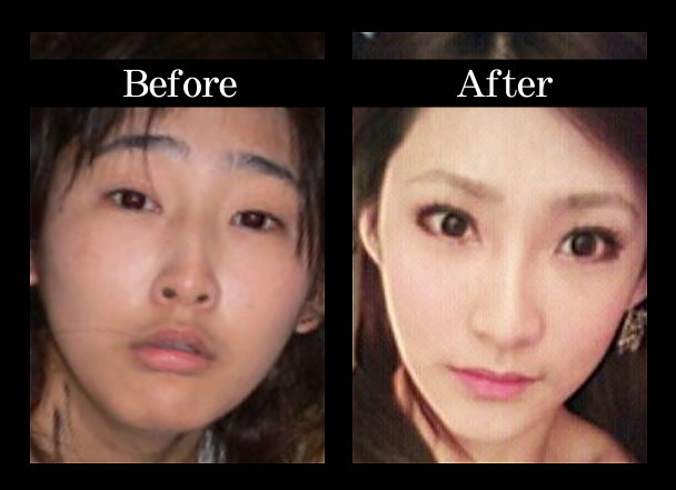 韓式隆鼻案例照片